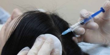 Thérapie par injection d'ozone pour les cheveux